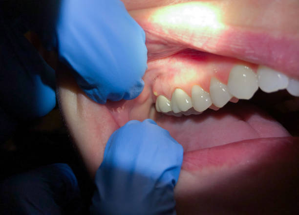 Best Emergency Root Canal Treatment in Parklawn, CA